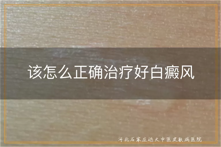 该怎么正确治疗好白癜风
