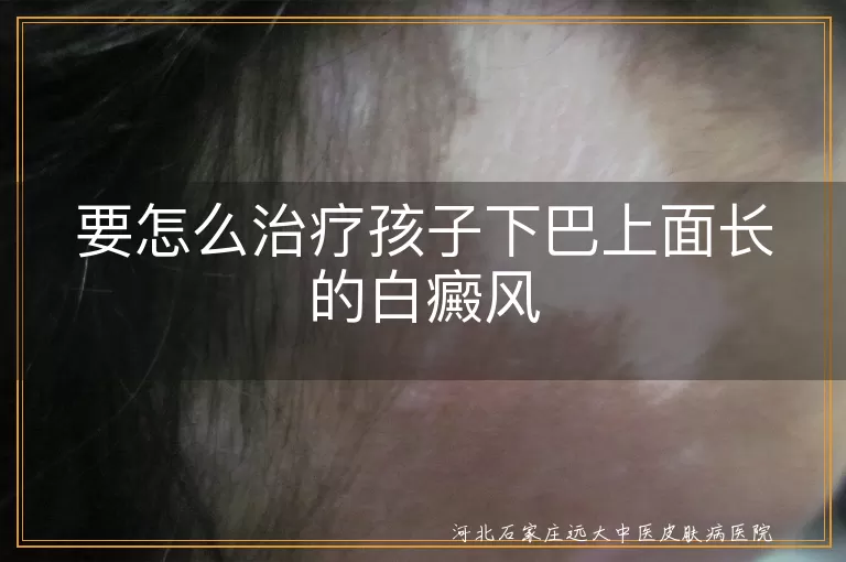 `儿童下巴白癜风治疗方法,小孩下颌白斑怎么治,孩子下巴长白癜风能治好吗`