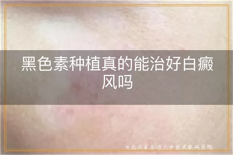 黑色素种植真的能治好白癜风吗
