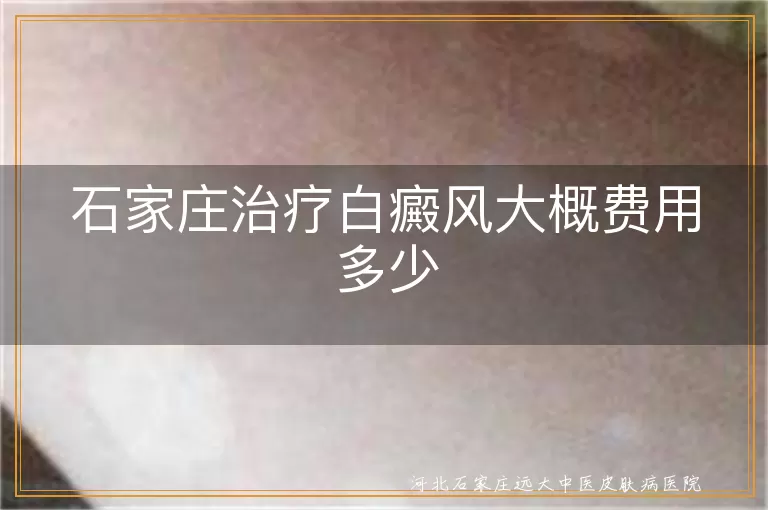 `石家庄治疗白癜风花费大概多少,白斑医治费用受哪些因素影响,白癜风治疗价格是多少`