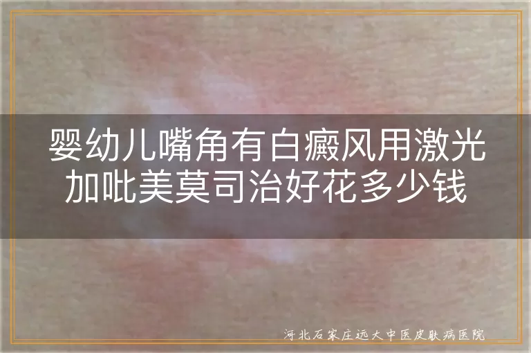 `婴幼儿嘴角白癜风激光治疗费用是多少,宝宝嘴角白斑吡美莫司加光疗价格,婴幼儿面部白癜风联合治疗花费`