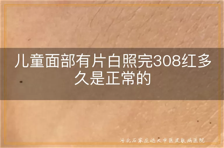 `儿童面部白斑照308激光后发红多久算正常,孩子脸上白癜风做308红肿多长时间正常,面部白斑患儿接受308治疗后泛红持续时间`