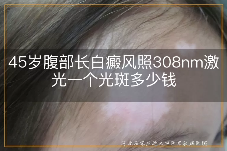`腹部白癜风照308激光费用,45岁患者白斑光疗价格,308nm准分子激光治疗白癜风怎么收费`