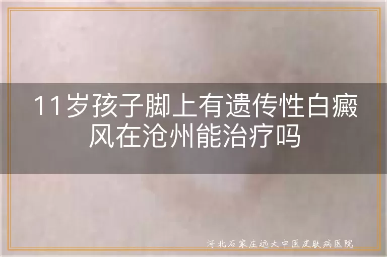 `儿童脚部遗传性白癜风沧州治疗方法,十一岁患儿足部白斑沧州能治好吗,沧州治疗儿童脚上白癜风效果怎样`