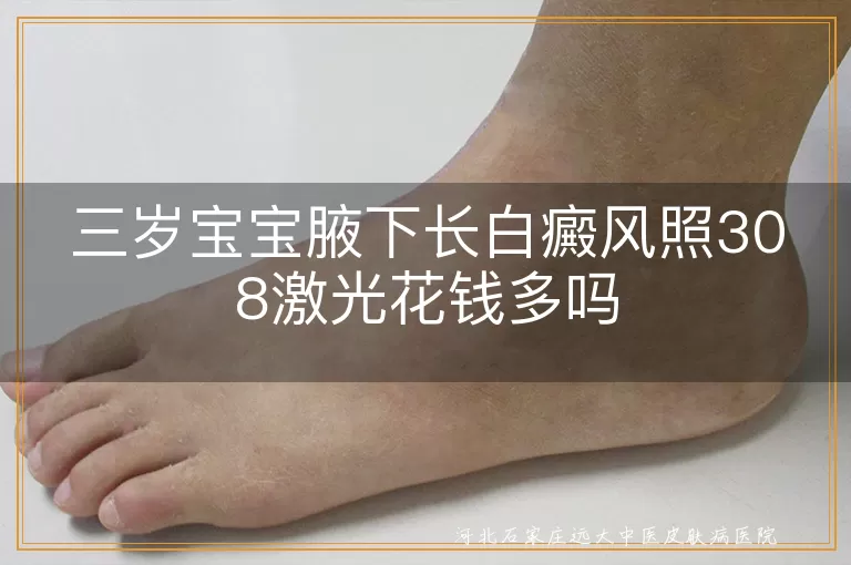 三岁宝宝腋下白癜风308治疗费用,儿童腋下白斑照激光花费多少,幼儿白癜风308激光价格贵吗