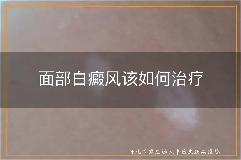 面部白癜风怎么治疗比较好,脸上白癜风应该如何医治,面部白斑怎样治疗见效快