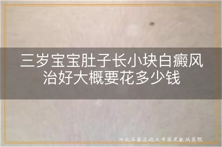 三岁宝宝肚子白斑治疗费用,幼儿腹部白癜风治疗多少钱,儿童肚子白斑治好费用多少