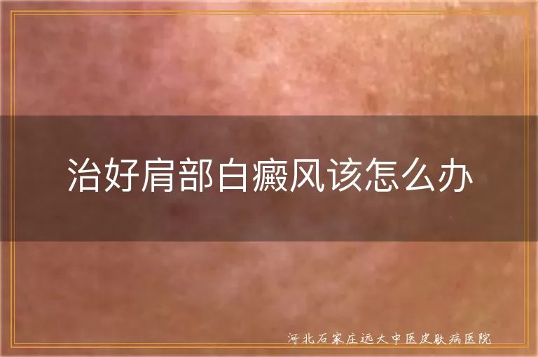肩部白癜风怎么治疗好,肩膀白斑如何治,肩部白癜风该怎么办