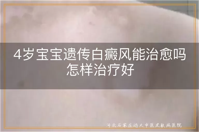 4岁宝宝白癜风怎么治疗,儿童遗传性白斑能治好吗,幼儿白癜风治疗方法
