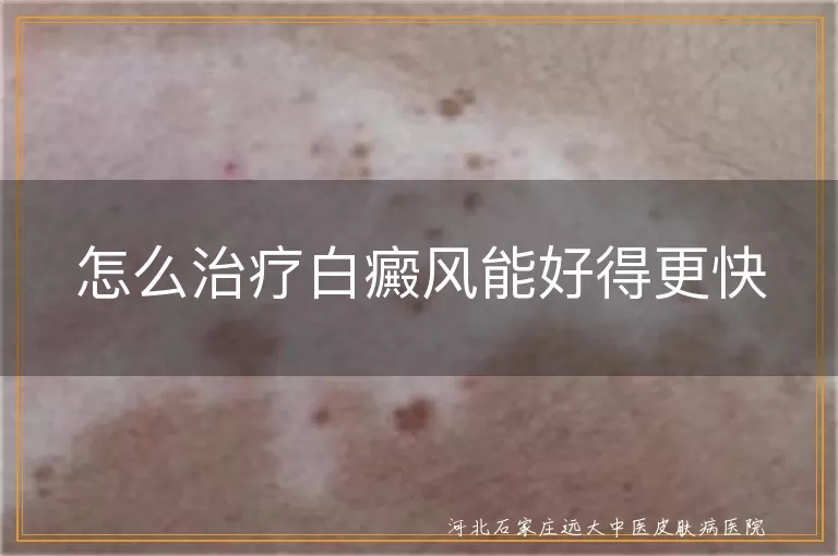 白癜风怎么治疗好得更快,白斑怎么治才能恢复快,白癜风快速恢复治疗方法