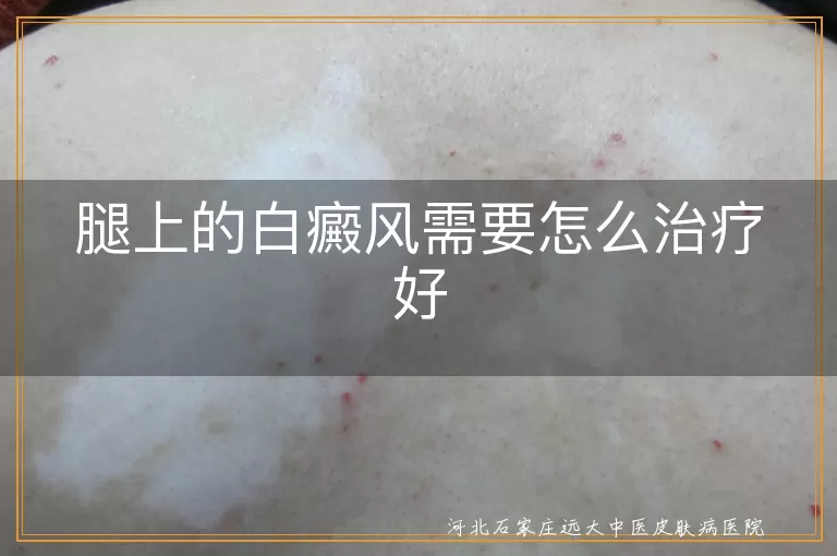 腿部白癜风怎么治疗效果好,腿上有白斑要怎么治疗好,腿上白癜风治疗方法有哪些