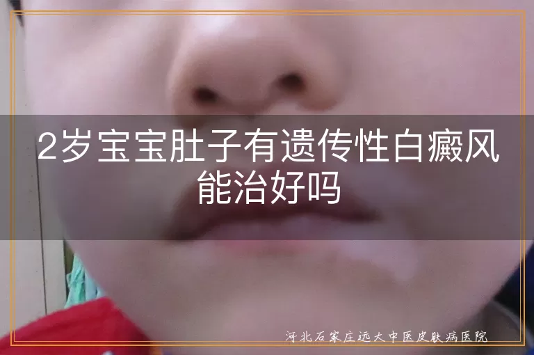2岁宝宝肚子有遗传性白癜风能治好吗