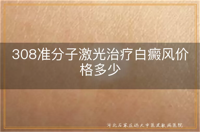 308准分子激光治疗白癜风价格多少