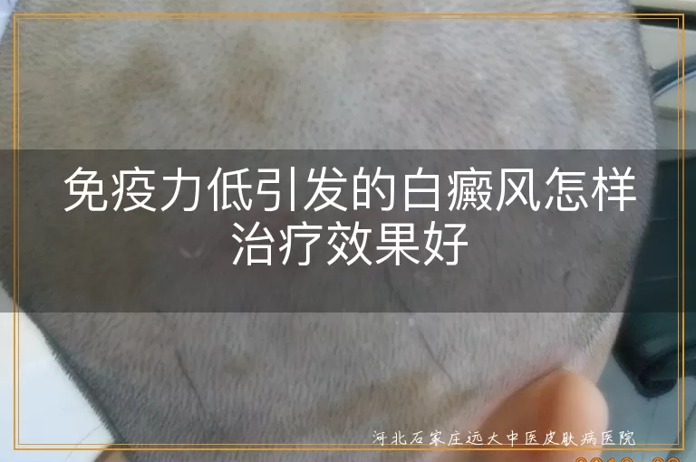 免疫力低引发的白癜风怎样治疗效果好