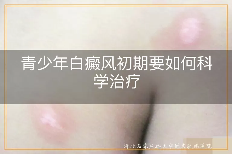 青少年白癜风初期怎么治疗,青少年白斑早期能治好吗,少年白癜风刚开始怎么治