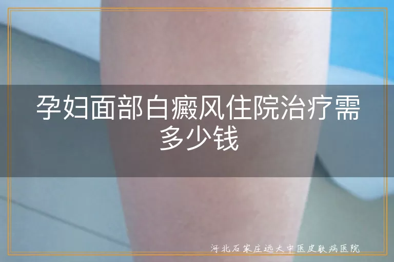 孕妇面部白癜风住院治疗需多少钱