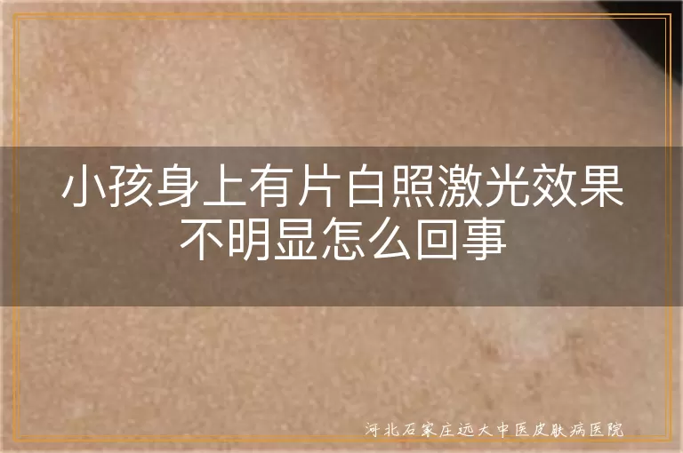 小孩身上有片白照激光效果不明显怎么回事