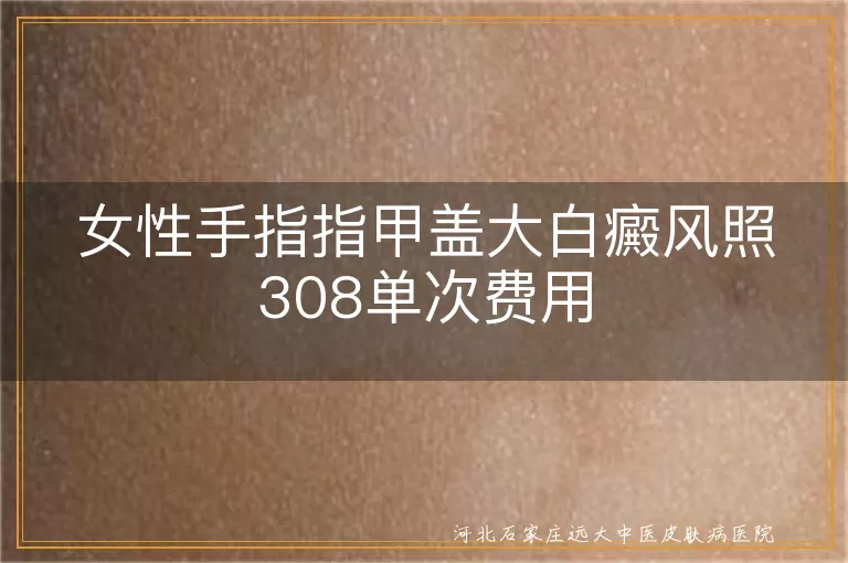 女性手指指甲盖大白癜风照308单次费用
