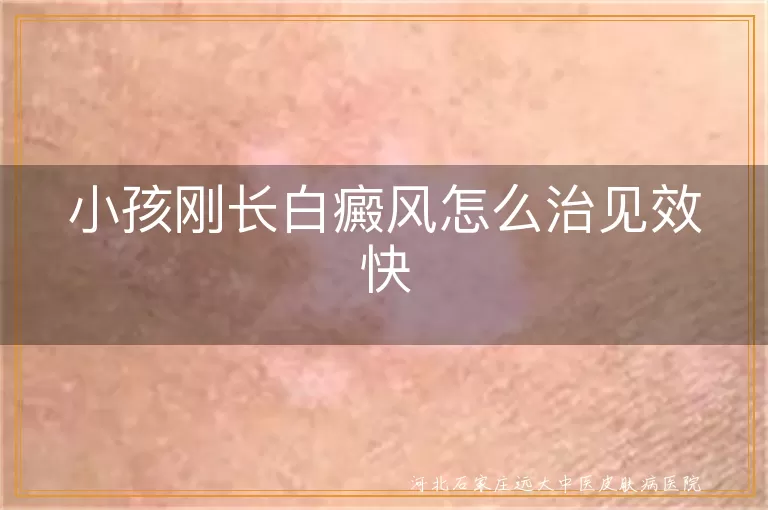 小孩刚长白癜风怎么治见效快