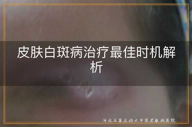 白癜风最佳治疗时间,白斑病早期治疗好,白癜风什么时候治效果好