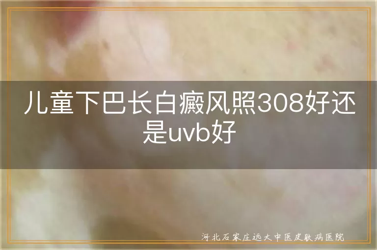 儿童下巴白斑照308还是uvb好,小孩面部白癜风选哪种光疗,儿童下颌白斑光疗对比