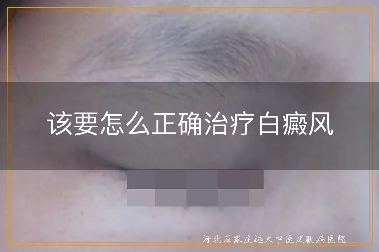 白癜风正确治疗方法有哪些,白斑患者怎么治疗效果好,得了白癜风该如何正确治疗