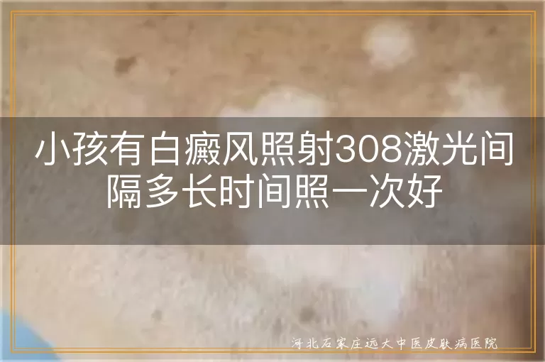 儿童白癜风照光间隔多久, 小孩白斑308治疗频率, 白癜风孩子激光多久照一次