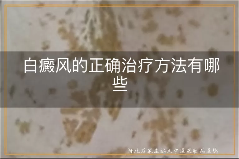 白癜风正确治疗方法有哪些, 白斑科学治疗方式有什么, 白癜风怎么治疗效果好