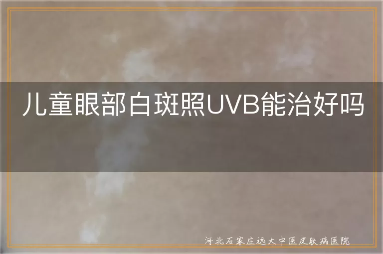 儿童眼部白斑照UVB能治好吗