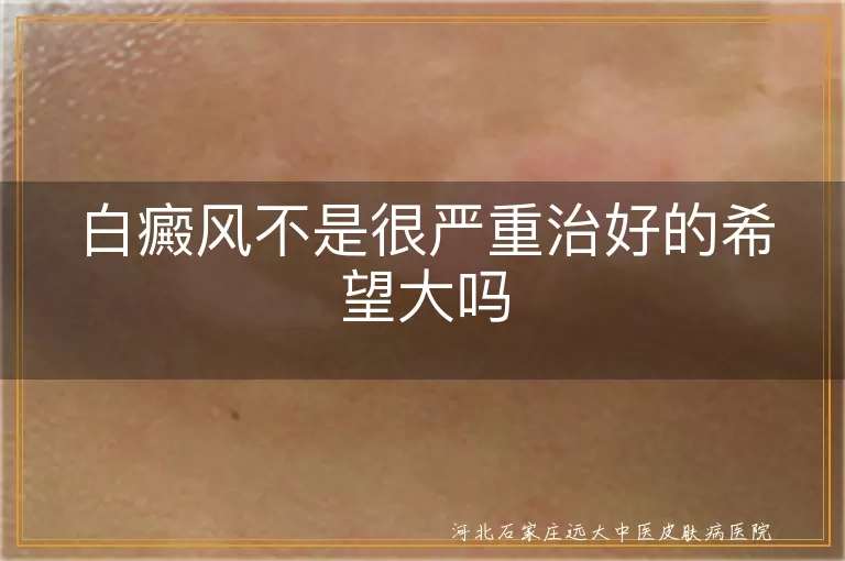 白癜风不是很严重治好的希望大吗