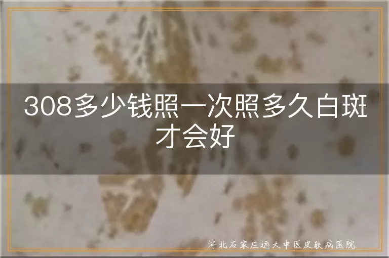 白癜风照308激光多少钱一次,白斑照308多久能治好费用多少,308治疗白癜风价格及疗程多久