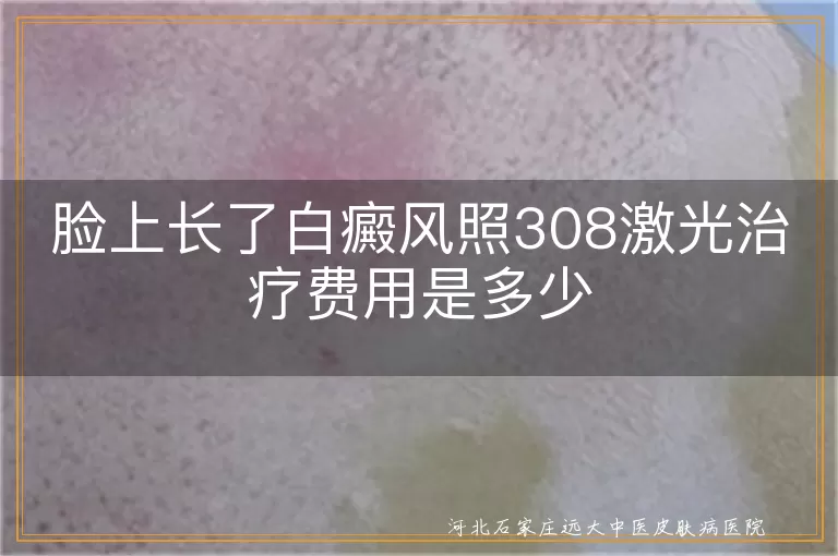 脸上长了白癜风照308激光治疗费用是多少