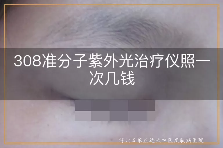 白癜风照308激光一次多少钱,白斑做308光疗一次费用多少,308治疗白癜风单次价格贵吗
