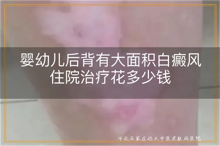 婴儿后背白癜风治疗要多少钱,宝宝身上白斑住院费用多少,婴幼儿白癜风治疗费用贵吗