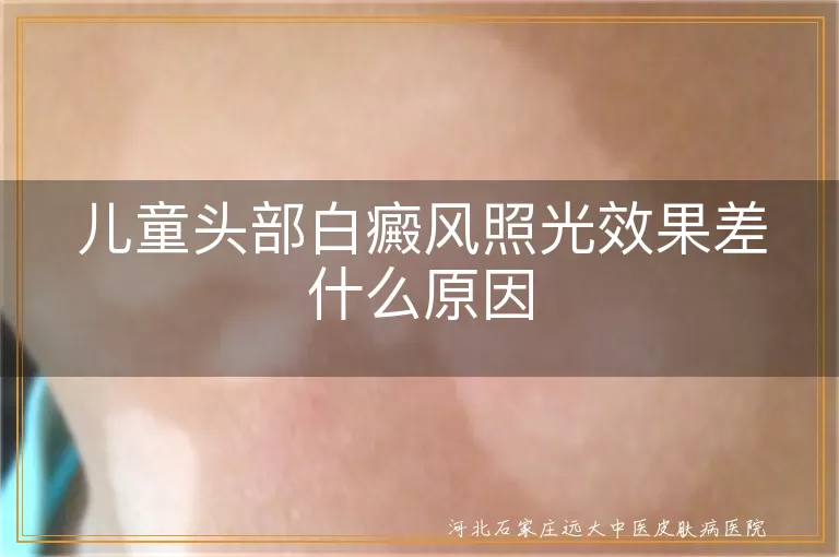 儿童头部白癜风激光效果不明显,孩子头皮白斑照光没效果咋回事,儿童头部长白癜风治疗不见好原因
