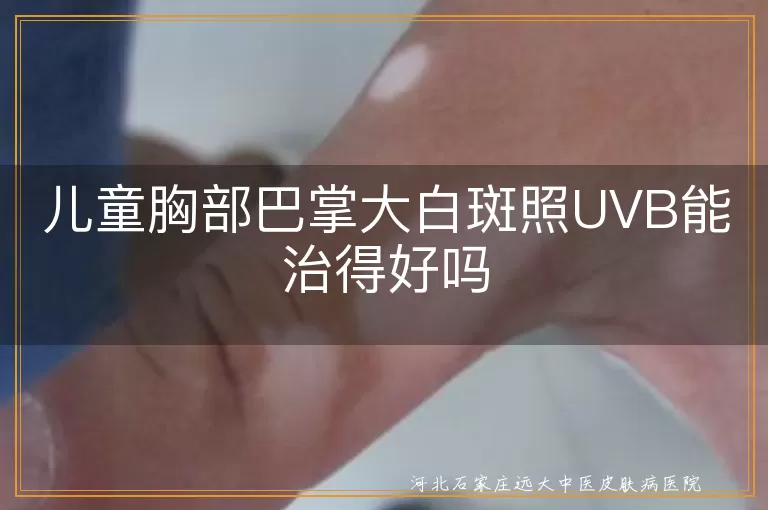儿童胸部巴掌大白斑照UVB能治得好吗