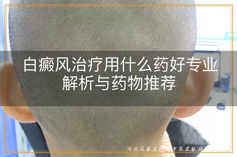 白癜风治疗用什么药好专业解析与药物推荐