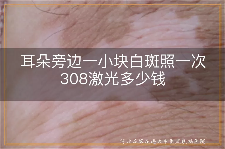 耳朵旁边一小块白斑照一次308激光多少钱