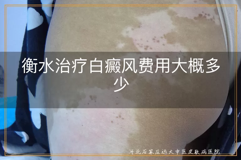 衡水治疗白癜风要花多少钱,衡水看白癜风费用是多少,衡水白斑治疗费用贵吗