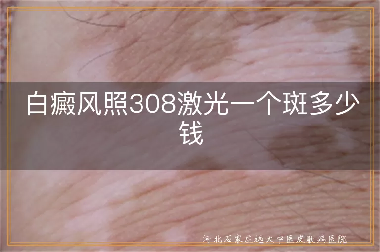 白癜风照308激光一个斑多少钱