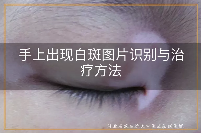 手上出现白斑图片识别与治疗方法