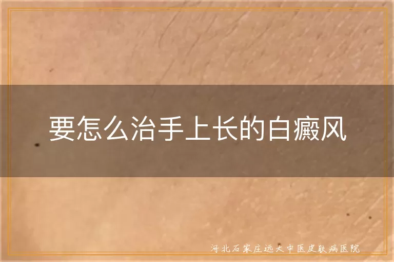 手上长白癜风要怎么治,手部白癜风治疗方法有哪些,手指白斑如何有效治疗