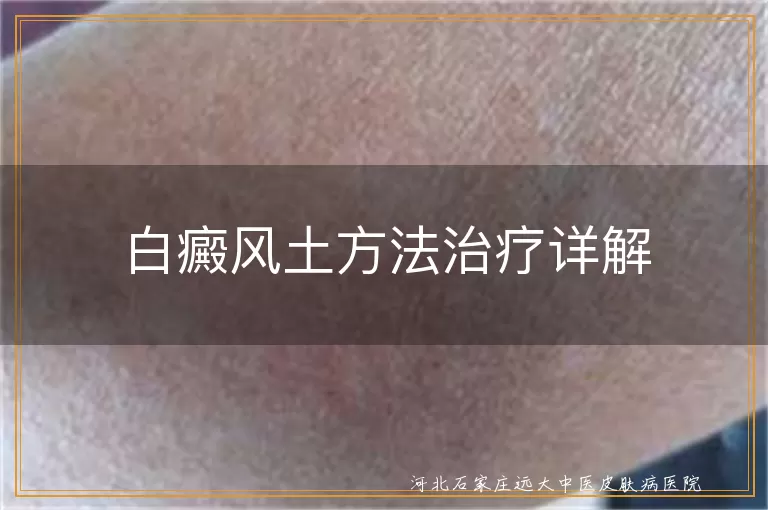 白癜风土方法治疗详解