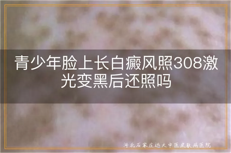 青少年脸上长白癜风照308激光变黑后还照吗