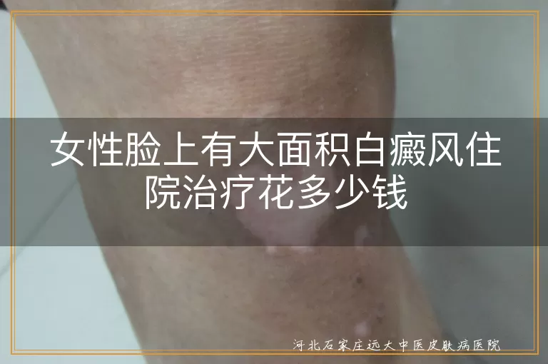 女性脸部白癜风住院费用多少,面部白斑治疗要花多少钱,大面积白癜风住院治疗价格