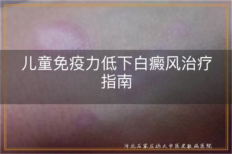 儿童免疫力低下白癜风治疗指南