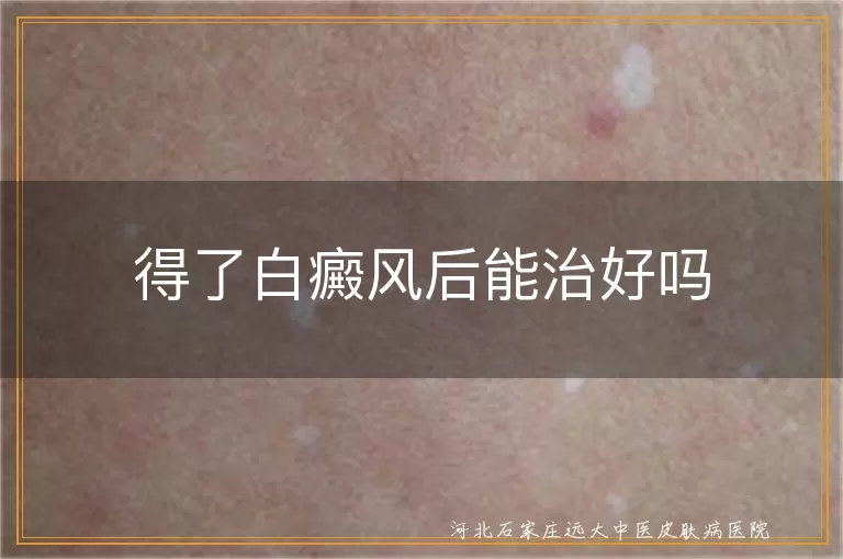 得了白癜风后能治好吗