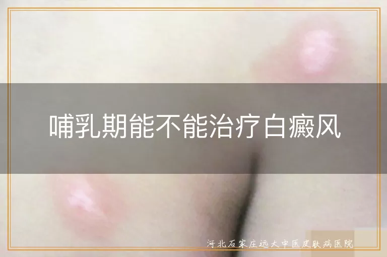 哺乳期能不能治疗白癜风