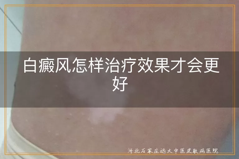 白癜风怎样治疗效果才会好,白斑怎么治疗才能效果好,白癜风如何治疗恢复更快