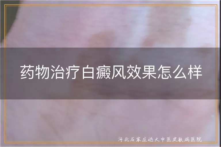 药物治疗白癜风效果好不好,白癜风药物治疗效果怎么样,白斑用药治疗效果如何
